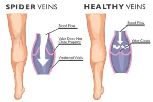 laser spider vein philadelphia